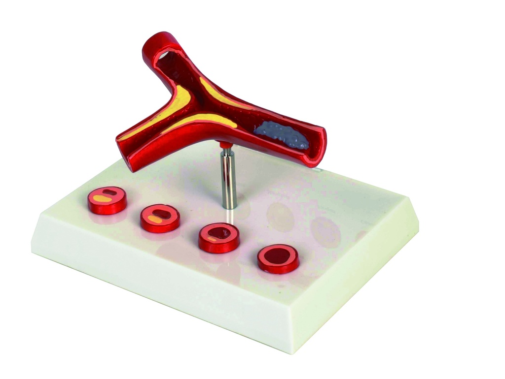 Modèle d'artère avec 4 sections