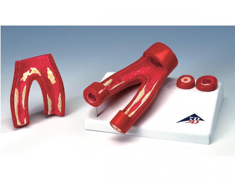 Modèle d'arthère avec athérome (athérosclérose)