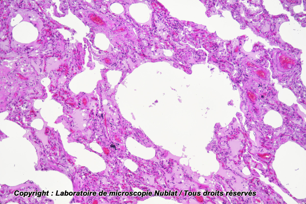 Pathologie: Poumon fumeur - homme - HE - Nublat