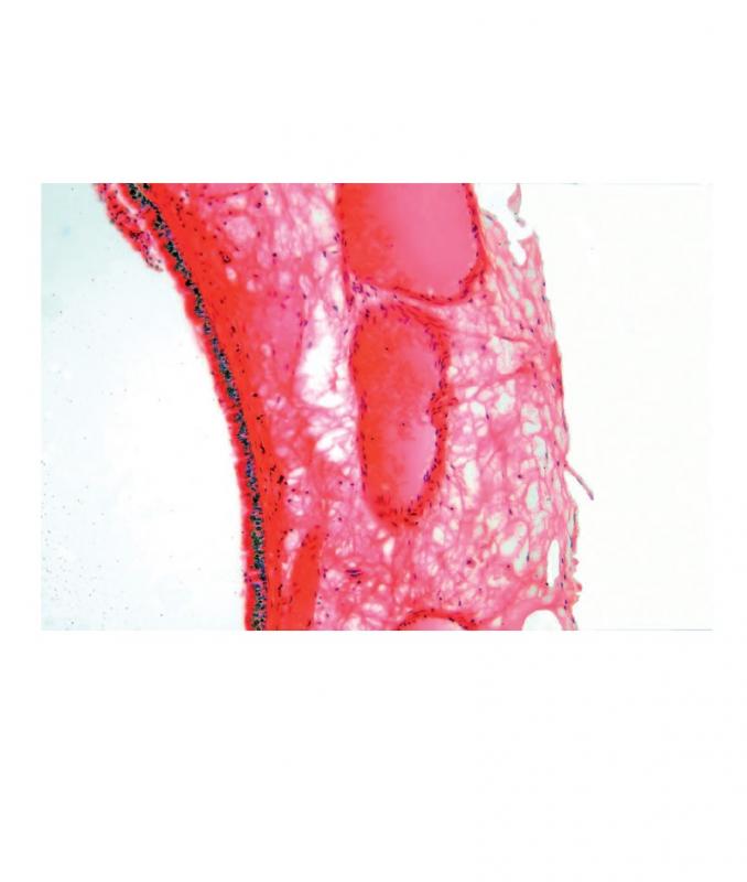 Préparation microscopique: Pathologie: Poumon fumeur - homme