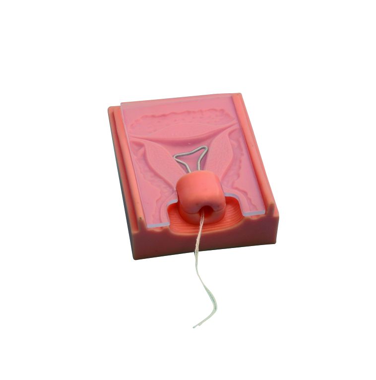 Mise en place d'un stérilet