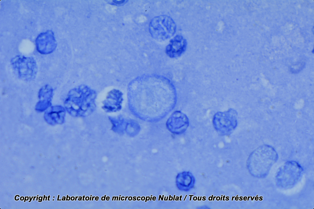 Macrophages - frottis liquide péritonéal - Nublat