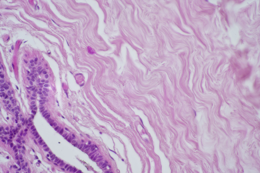 [027690] Cancer du sein - Nublat