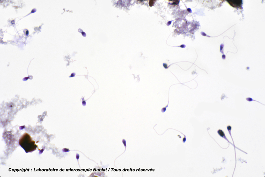 [#027697] Spermatozoïdes pathologiques - homme - Nublat