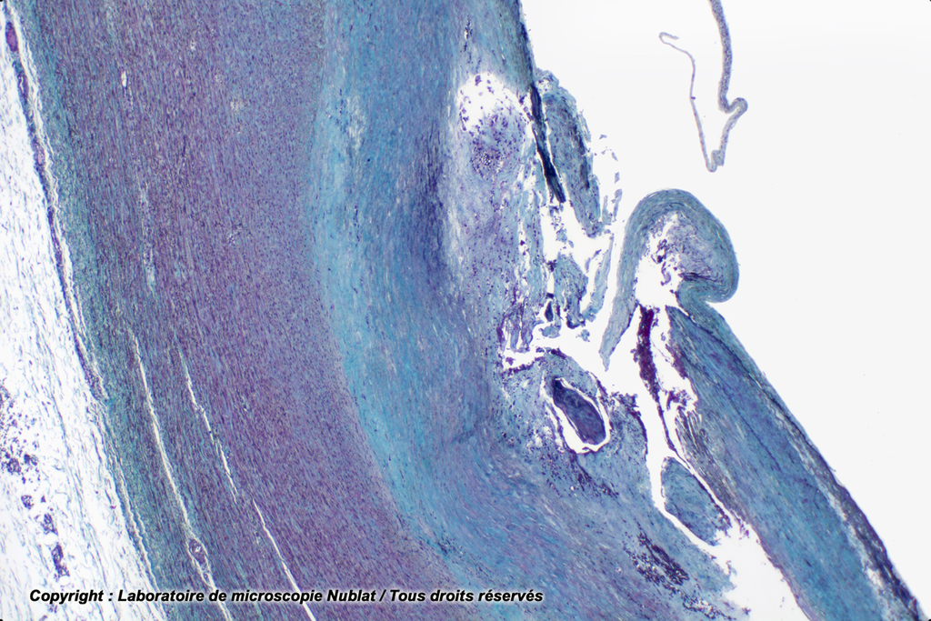 [027699] Artère (aorte) avec athérome - Nublat