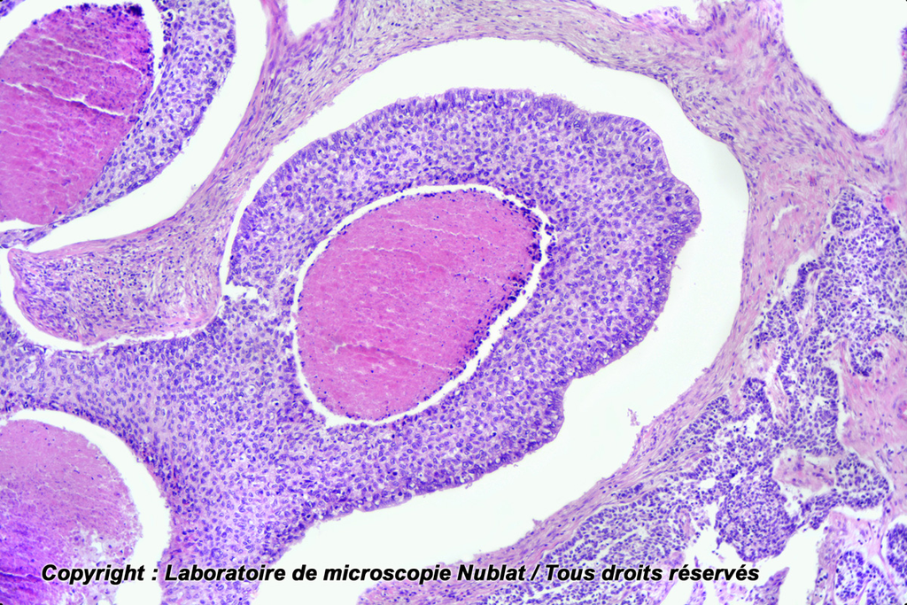 [027704] Cancer papillomavirus du col de l’utérus - Nublat