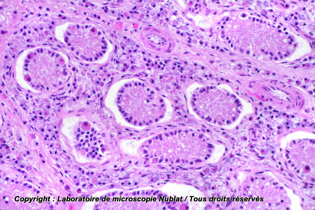 Testicule cryptorchide - Nublat