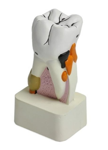[S68458] Modèle de dent avec maladies dentaires